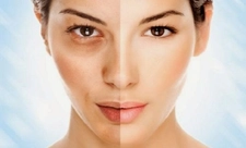 Göz Altı Morarması Belirtileri ve Tedavisi