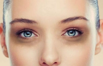 Göz Altı Kararması Nasıl Geçer?