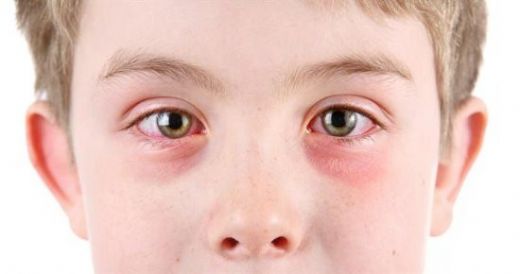 goz alti alerjisi belirtileri ve tedavisi gozalti gen tr